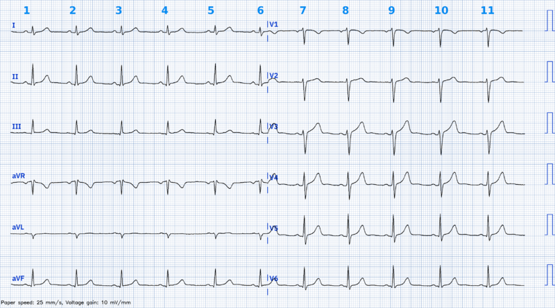 Fichier:Methode compter qrs.png