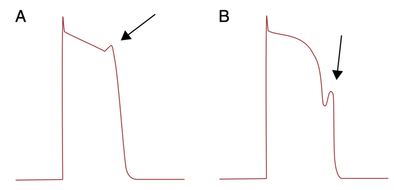 Fichier:Post-dépolarisations précoces.png