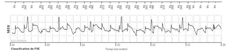 Fichier:Artefact ilr irm.png