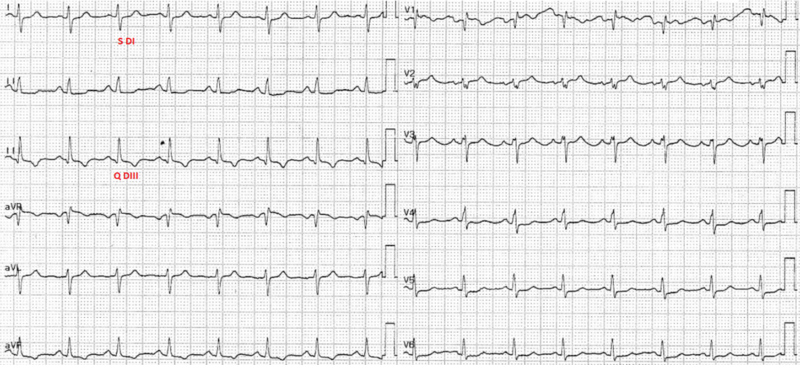 Fichier:S1Q3 - embolie pulmonaire.png