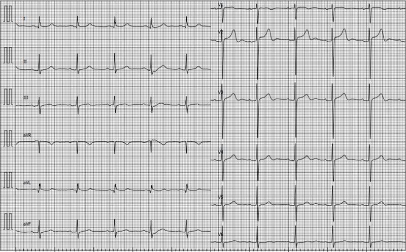 Fichier:ECG HVG 2.png