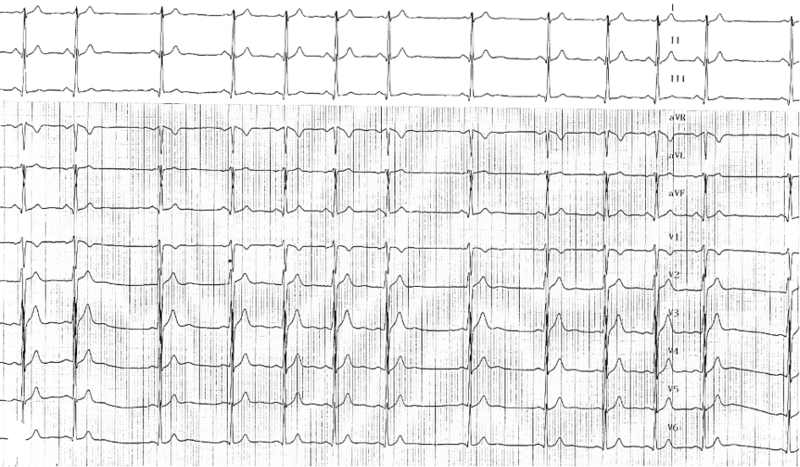 Fichier:Arythmie sinusale respiratoire physio.png
