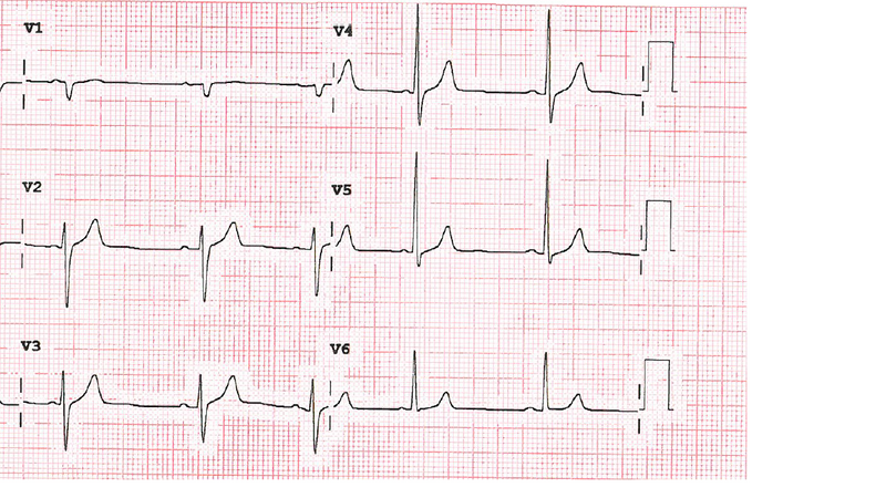 Fichier:Ecg précordium.png