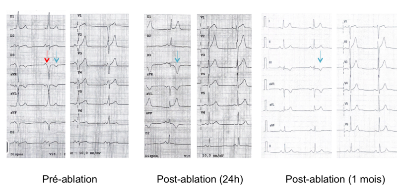 Fichier:Mémoire cardiaque .png