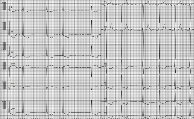 Fichier:ECG HVG 1.png