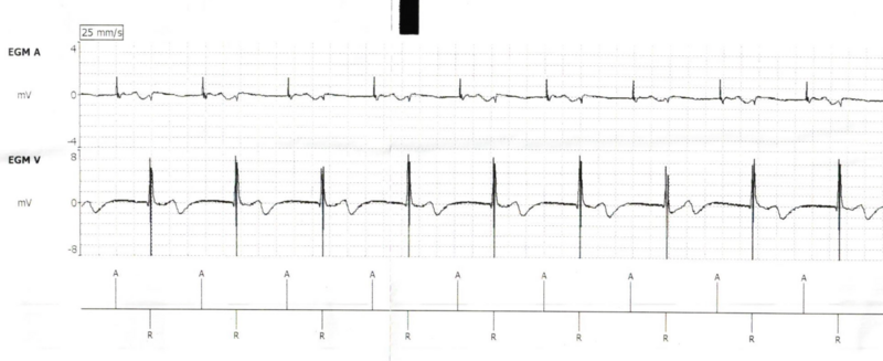 Fichier:EGM ECG base.png