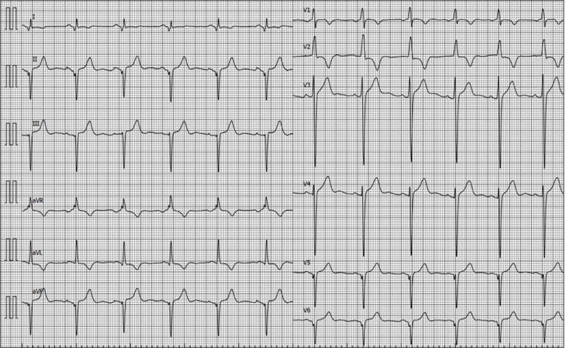Fichier:ECG CMH 1.png