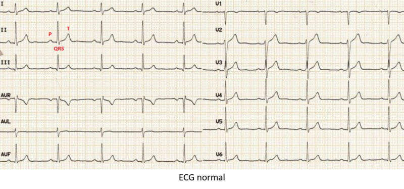 Fichier:ECG normal.png