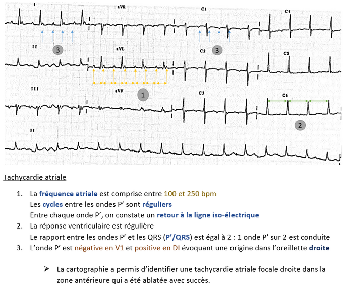 Fichier:Tachycardie atriale droite.png