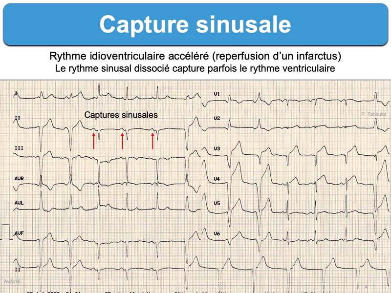 Fichier:Capture-sinusale-ecg-taboulet-RIVA-Av2a16.jpg