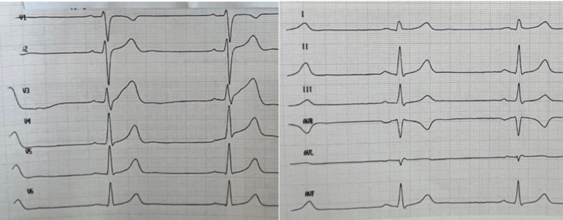 Fichier:Onde q septal.png