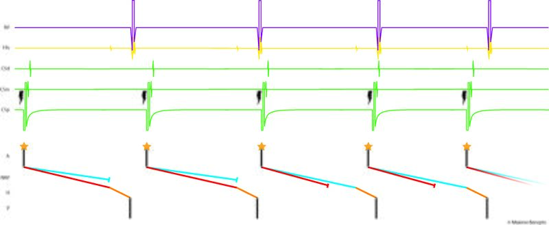 Fichier:Figure 10 - Wenckebach.jpg