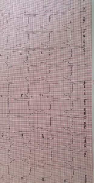 Fichier:Stimulation apicale2.jpg