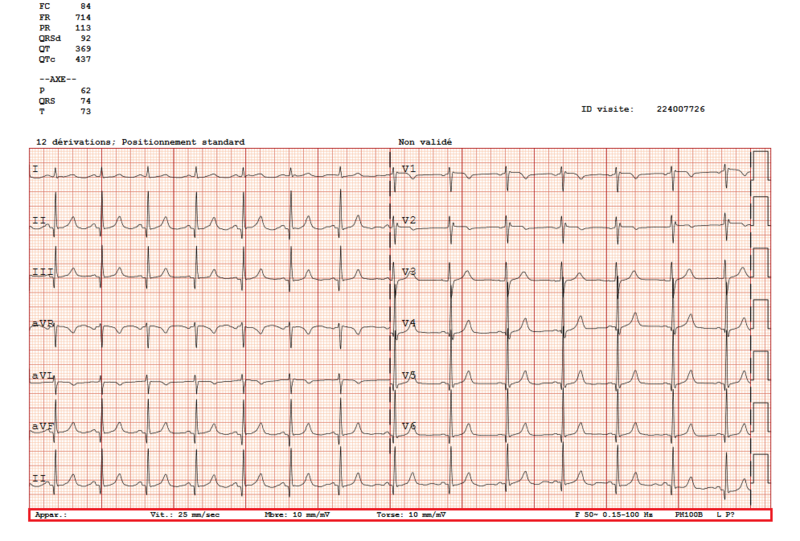 Fichier:Exemple d'ECG avec calibration standard..png