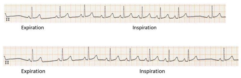 Fichier:Arythmie sinusale respiratoire.png