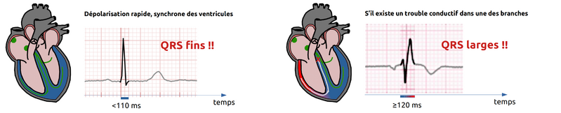 Fichier:Qrs fins.png