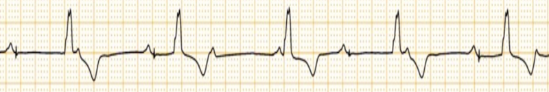 Fichier:Défaut de capture ventriculaire.png