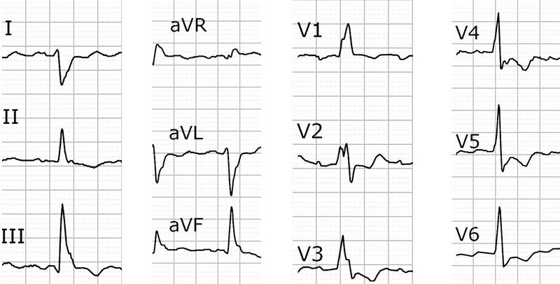 Fichier:ECG 12D TOF.jpg