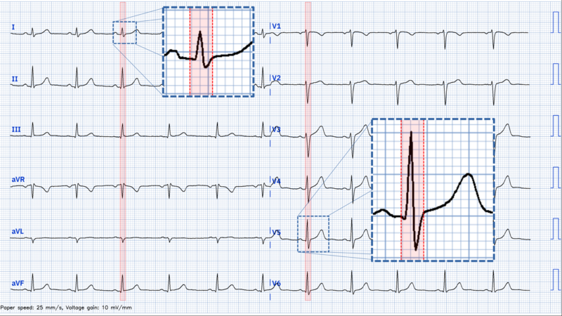 Fichier:Qrs109.png
