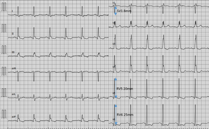 Fichier:ECG HVG 4.png