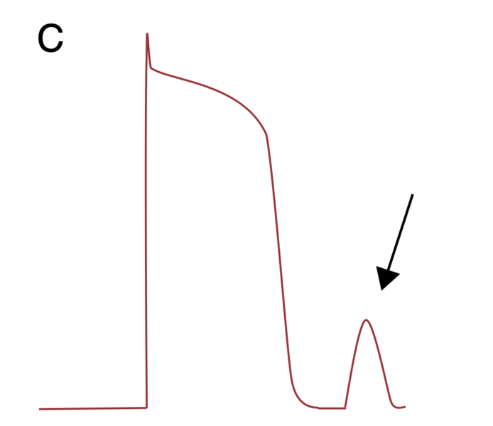 Fichier:Post-dépolarisations tardives .png