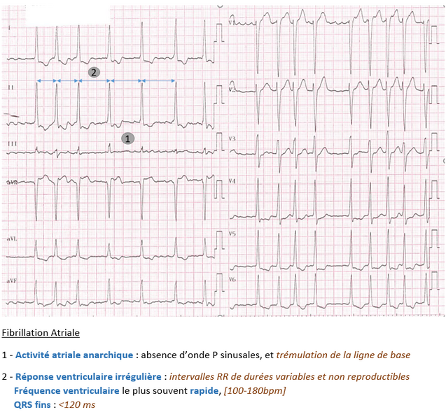 Fichier:Fibrillation atriale .png