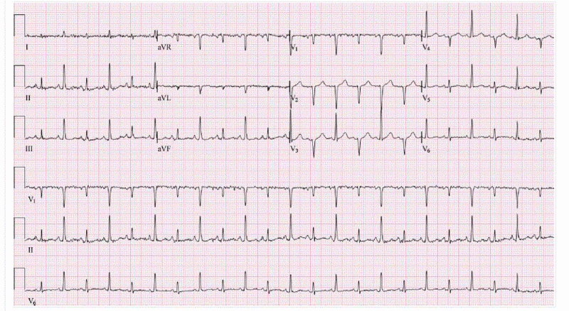 Fichier:Alternance qrs.gif