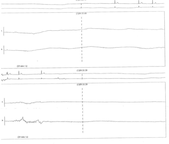 Fichier:ECG cardioinhibition.png