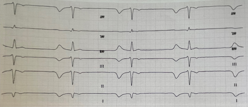 Fichier:Onde q physiologique.png