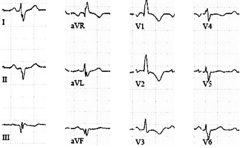 Fichier:ECG Ebstein.jpg
