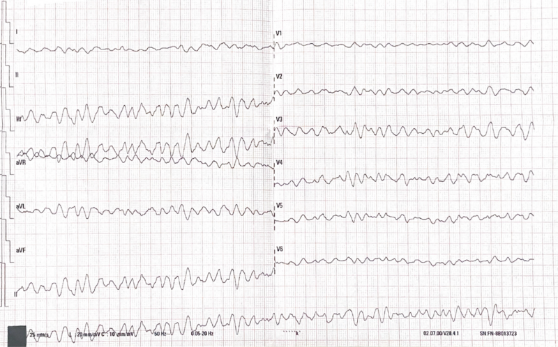 Fichier:ECG FV.png