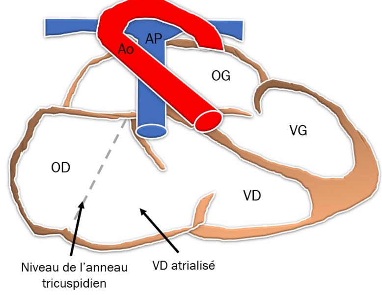 Fichier:Anatomie Ebstein.png