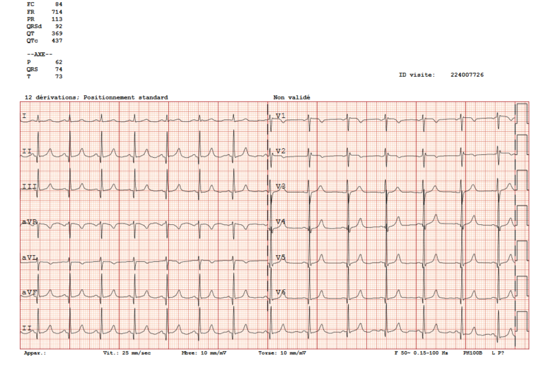 Fichier:Exemple d'ECG avec calibration standard.png
