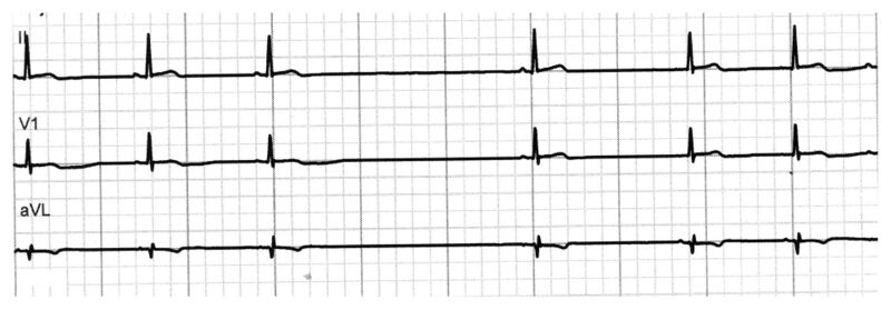 Fichier:ECG PS.jpg