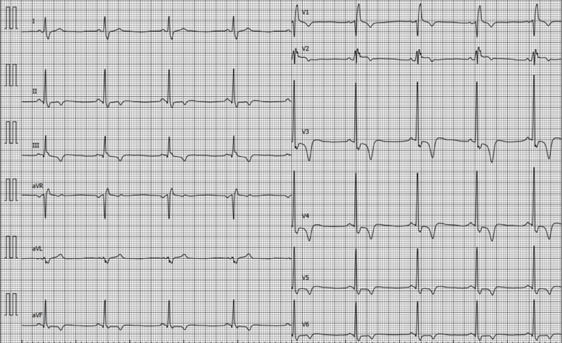 Fichier:ECG CMH 4.png