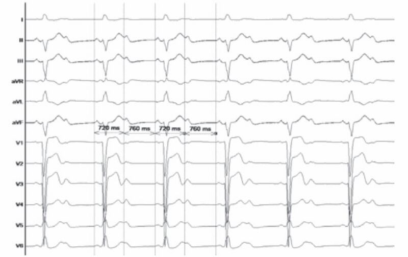 Fichier:Arythmie ventriculophasique.jpg