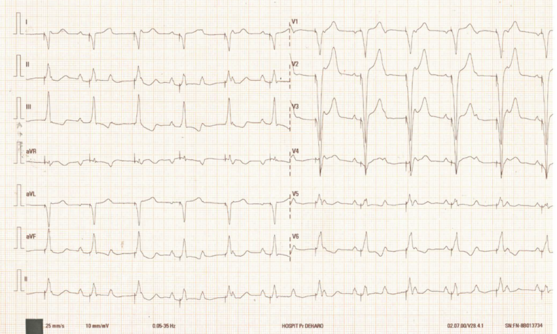 Fichier:Stimulation ventriculaire droite septale.png
