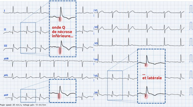 Fichier:Ondes Q.png