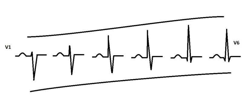 Fichier:QRS progression.png