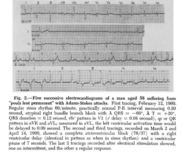 Fichier:5 ECG d’un patient de 58 ans souffrant de « pouls lent permanent » avec syncopes de type Adams-Stokes, décrits par Lenègre. .jpg