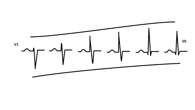 Fichier:QRS evolution.png