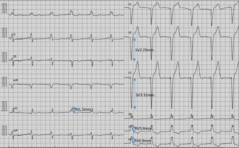 Fichier:ECG HVG 3.png