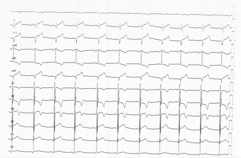 Fichier:ECG CMH 3.png