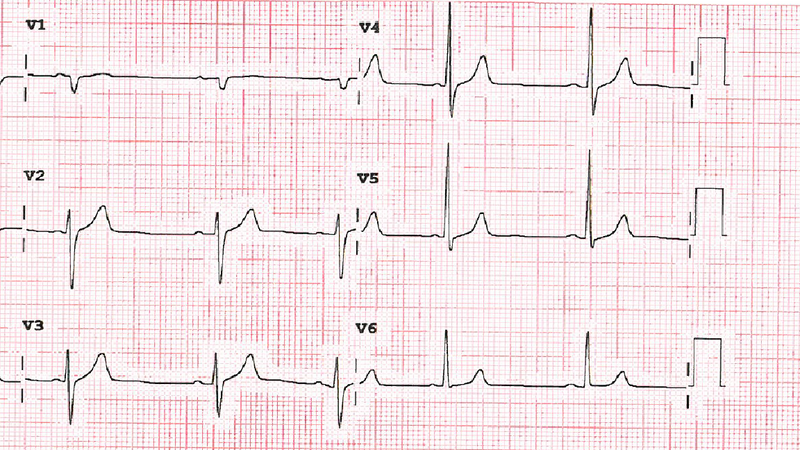 Fichier:QRS précordium.png